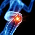 Artrosi o Osteoartrosi: la malattia degli ultraquarantenni colpisce il 40% della popolazione